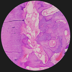 Poster - Distal femur (biopsy): Exostosis. Section show mature hyaline cartilage with overlying fibrous perichondrium.