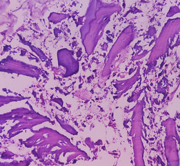 Canvas Print - Distal femur (biopsy): Exostosis. Section show mature hyaline cartilage with overlying fibrous perichondrium.