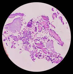 Poster - Distal femur (biopsy): Exostosis. Section show mature hyaline cartilage with overlying fibrous perichondrium.