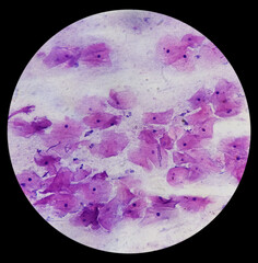 Wall Mural - Light micrograph of a vaginal smear showing adenocarcinoma cells (center). Vaginal cancer. Inflammatory smear with HPV related changes. Cervical cancer. SCC.