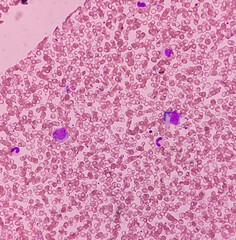 Poster - Acute leukemia, ALL(Acute lymphoblastic leukemia), peripheral blood smear. abnormal hematological blood cell. Bone marrow study.