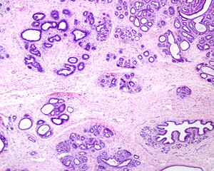 Poster - Human breast adenosis