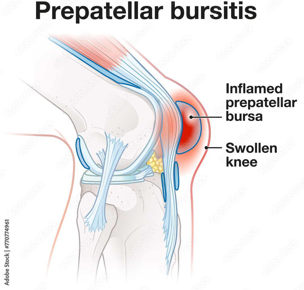 Prepatellar bursitis. Inflammation of the bursa in front of the kneecap ...