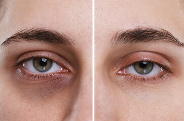 Collage with photos of woman with dark circle under eye before and after treatment, closeup