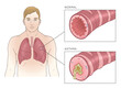 Normal and asthmatic bronchioles with man. Asthma medical vector illustration.