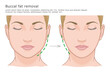 Buccal fat removal surgery illustration. Before and after. Plastic surgery medical illustration. 