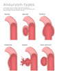 Several types of aneurysm with normal vessel and rupted aneurysm medical vector illustration. 