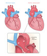 Normal heart and heart with ascending aortic aneurysm vector medical illustration labeled. 