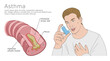Asthmatic airway diagram and man with inhaler. Asthma medical vector illustration.