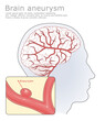 Brain aneurysm and human head with circulatory system medical vector  illustration.