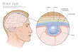 Arachnoid (intracranial) Cyst of the brain labeled medical vector  illustration.