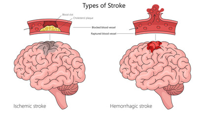 Wall Mural - Human ischemic stroke and hemorrhagic stroke in human brain anatomy structure diagram hand drawn schematic vector illustration. Medical science educational illustration