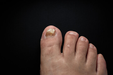 A person's foot has a yellow toenail due to a fungal infection