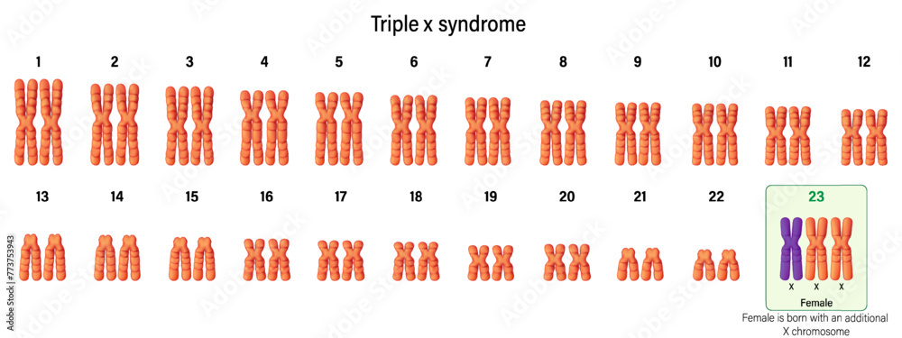 Vector De Stock Karyotype Of Triple X Syndrome XXX Female Has An vector-de-stock-karyotype-of-triple-x-syndrome-xxx-female-has-an