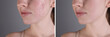 © New Africa - Acne problem. Young woman before and after treatment on grey background, closeup. Collage of photos
