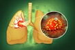 3d rendered, medically accurate illustration of lung cancer. showing presence of cancerous tumor inside the lungs