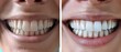 Before and after photo of a womans teeth postwhitening treatment showing a significant improvement in brightness and appearance. Concept Dental Whitening Results, Before and After Photos