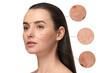 © New Africa - Dermatology. Woman with skin problem on white background. Zoomed areas showing acne