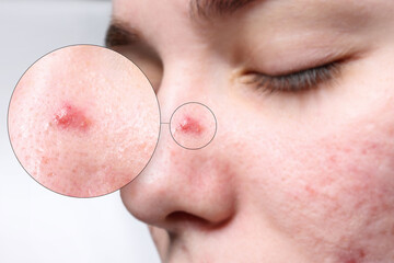 Wall Mural - Dermatology. Woman with skin problem on light background, closeup. Zoomed area showing acne