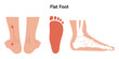 Flat foot deformity 