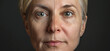 © Welle Photos - A detailed before and after photo of an elderly woman's face, showcasing the impact of skin implants on wrinkles and fine lines.