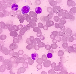 Wall Mural - Bone marrow study (BMD). Myelodisplastic syndrome (MDS) or Refractory anemia. It's a group of cancers in which immature blood cells in the bone marrow. Myelodysplasia.