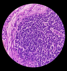 Poster - Inguinal lymph node (excised): Lymphoproliferative disorder (LPD). Section show lymph node.