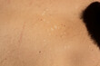 Skin Condition: Tinea Versicolor. Lack of pigmentation