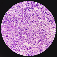 Wall Mural - Photomicrograph of Rectal cancer. IBD. IBS. Squamous cell carcinoma of the rectum. Grade 2 rectal cancer, microscopic view.