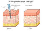 Fototapeta Dinusie - skin structure before and after collagen induction therapy using a micro-needling device for enhanced skin texture diagram schematic raster illustration. Medical science educational illustration