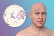 Lipoma on a man's forehead, 3D illustration and micrograph