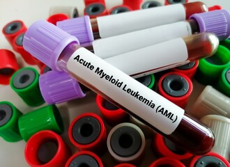 Canvas Print - Blood sample for Acute myelogenous leukemia (AML) test.