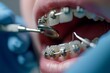 Close-Up View of Braces Installation in Dentist's Office