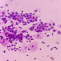 Wall Mural - Pap's smear. Inflammatory smear with HPV related changes. Cervical cancer. SCC.