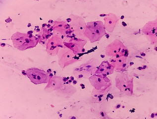 Poster - Pap's smear. Inflammatory smear with HPV related changes. Cervical cancer. SCC.