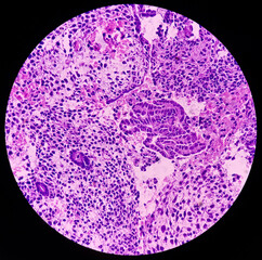 Canvas Print - Microphotograph of endometrial tissue, reveals decidual change with necrosis and hemorrhage. Endometriosis. Endometrial or uterine cancer diagnosis.