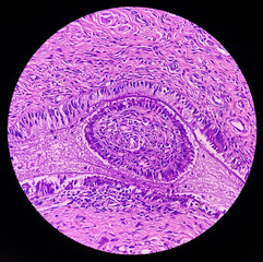 Canvas Print - Microphotograph of endometrial tissue, reveals decidual change with necrosis and hemorrhage. Endometriosis. Endometrial or uterine cancer diagnosis.