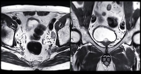 Wall Mural - MRI of the prostate gland reveals A 2.0x0.9x1.7 cm malignant prostate tumor at left posterior PZ, aiding in diagnosing tumors and guiding treatment decisions.