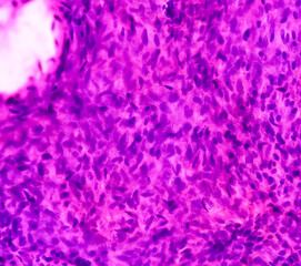 Poster - Parotid swelling cytology, Monomorphic adenoma. Smear show cellular material of epithelial cells in clusters and singly on the background of blood.