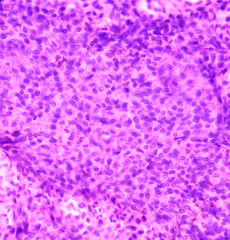 Wall Mural - Parotid swelling cytology, Monomorphic adenoma. Smear show cellular material of epithelial cells in clusters and singly on the background of blood.