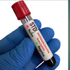 Canvas Print - Scientist holds Blood sample for STI or STD (Sexually Transmitted Disease) test with white background.