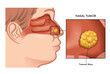 Medical illustration of a nasal tumor with a magnified detail.