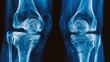 © chanidapa - x-ray OA knee both knee in blue tone, x-ray image of knee joint show mild degenerative change