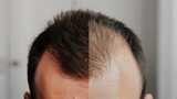 Fototapeta Tęcza - comparison of a mans hair before and after treatment for hair loss. Hair transplant