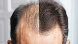 Fototapeta Tęcza - comparison of a mans hair before and after treatment for hair loss. Hair transplant