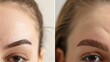 A young woman both before and after hair transplantation had bald eyebrows.