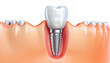 Dental implant in good lighting. Cross-section of an artificial jaw. Dentistry. Generative AI.

