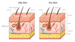 Human oily skin with dry skin, differences in sebaceous gland activity, pore size, and skin texture structure diagram hand drawn schematic raster illustration. Medical science educational illustration