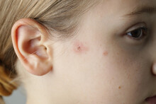 Facial Skin Closeup. Allergy, Dermatitis, Virus Or Bacterial Infection. Dermatology,  Medicine And Health Care Concept.