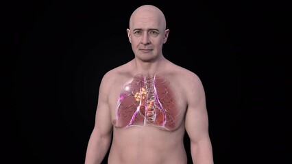 Poster - Primary lung tuberculosis in a man with the Ranke complex, 3D animation showing pulmonary lesion and mediastinal lymphadenitis with calcification.